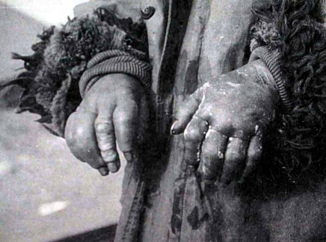 A gruesome frostbite experiment conducted by Unit 731.